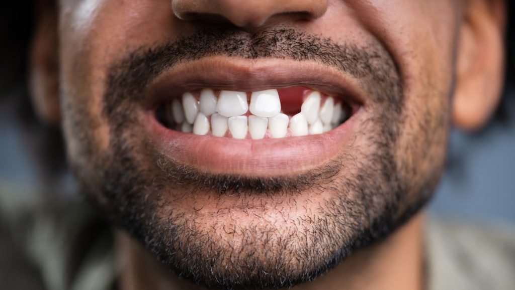 Man smiling with missing tooth