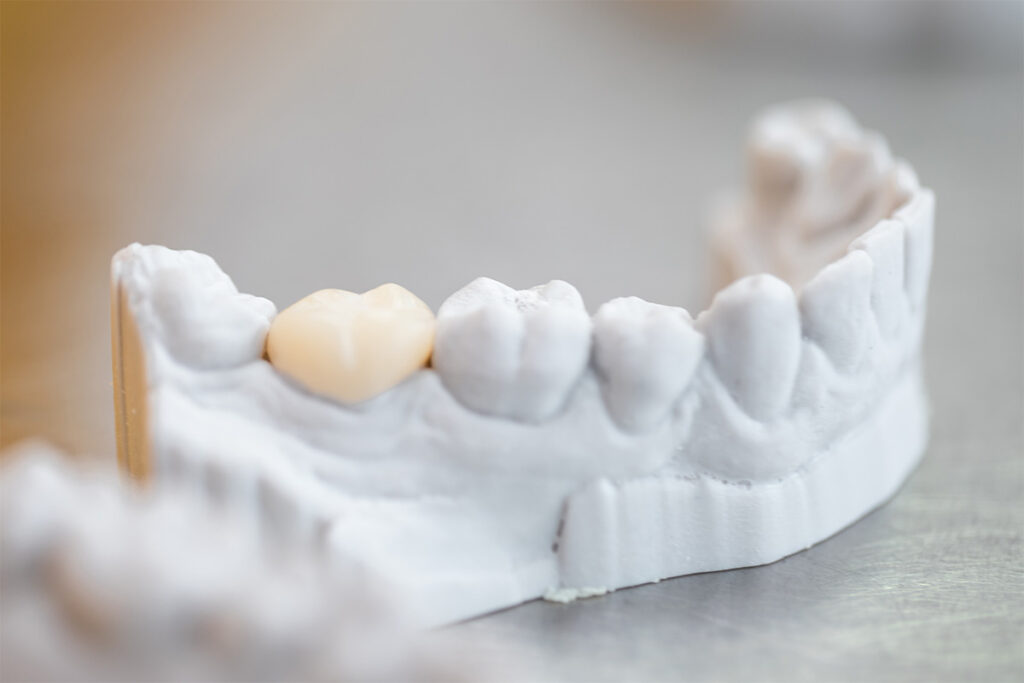 Dental implant being made in a lab to replicate the colour of a natural tooth